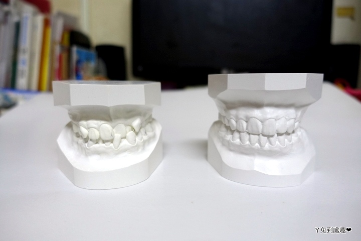 牙齒模型 矯正前後