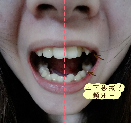 矯正牙齒2
