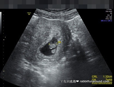 懷孕七週超音波照