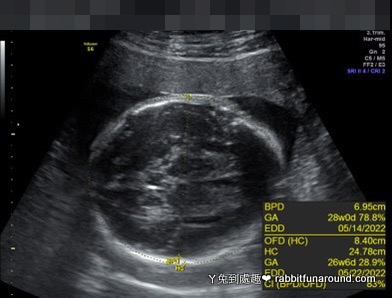 胎兒超音波26w+5d