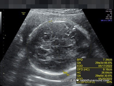 胎兒超音波28w+4d