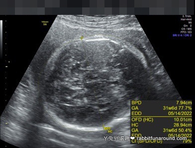 胎兒超音波30w+4d